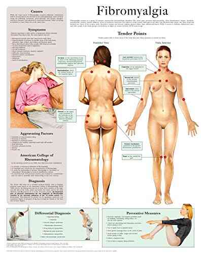 Fibromyalgia E Chart: Full Illustrated