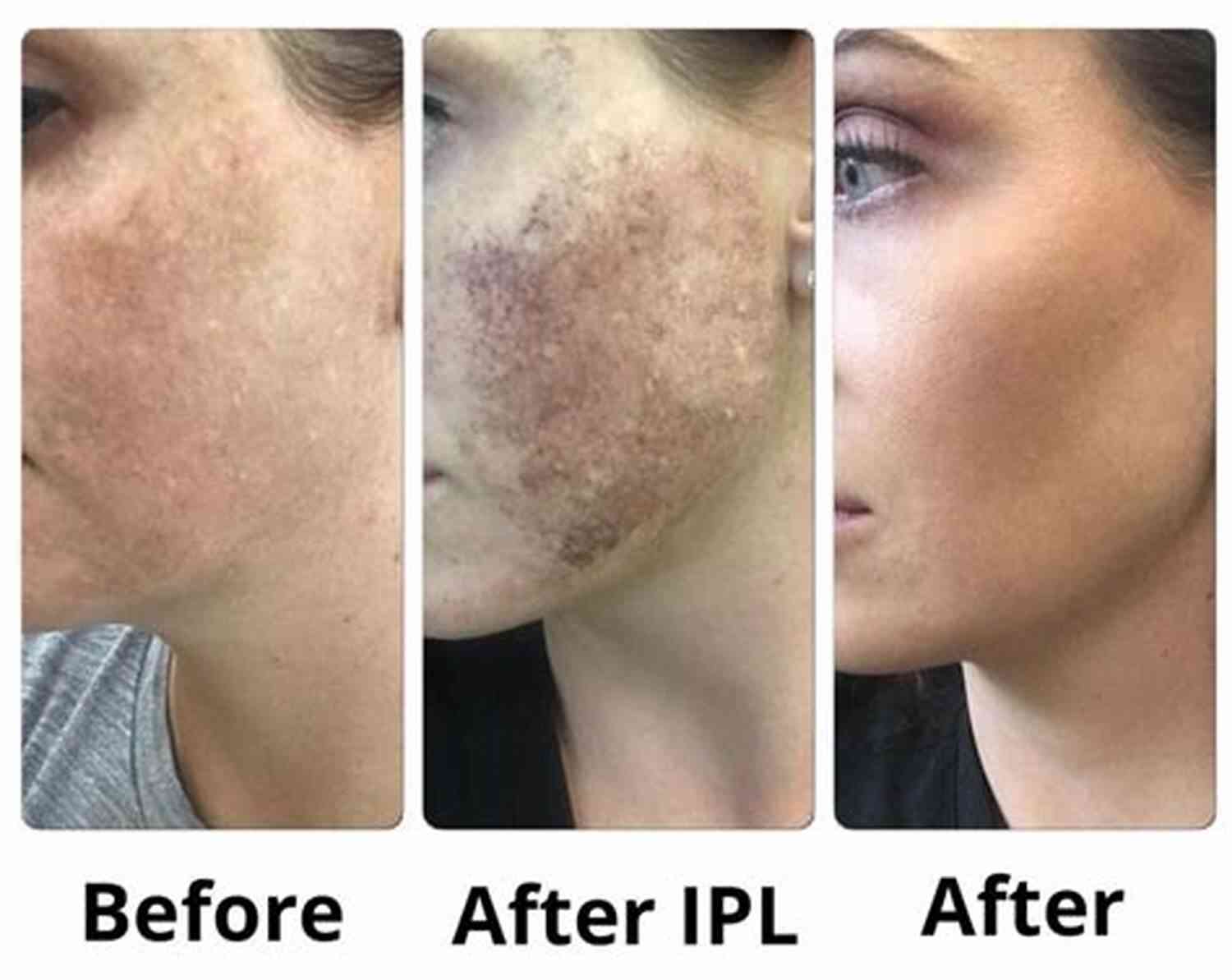Dark Spots Before And After Treatment Skin Theory: A Black Girls Guide To Skin Care