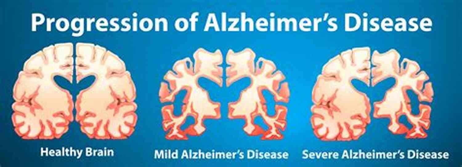 Illustration Of Alzheimer's Disease The Concise Human Body Book: An Illustrated Guide To Its Structure Function And Disorders