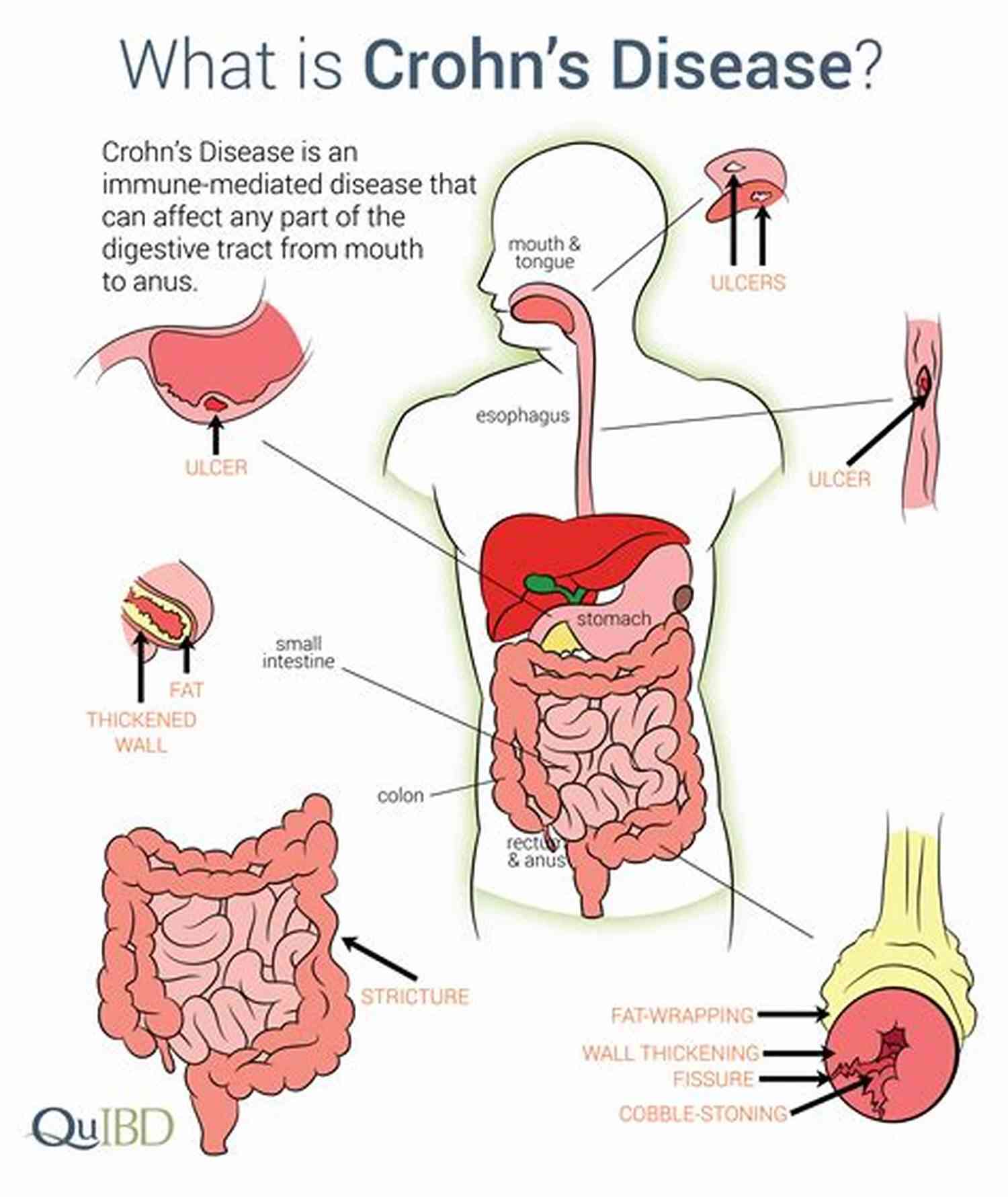 Illustration Of Crohn's Disease The Probiotics Bible: A Comprehensive Guide To Probiotics Prebiotics And Natural Healing (Crohn S Disease Gastrointestinal Disorders Stomach Aches Digestive Disorders Abdominal Pain GERD)